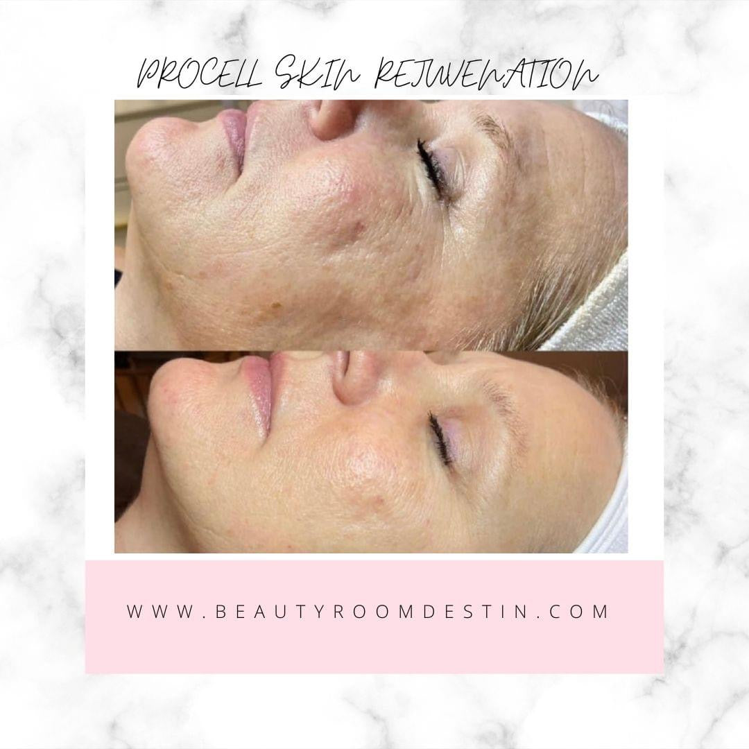 Discover the Magic of Procell Micro-Channeling at Beauty Room Destin