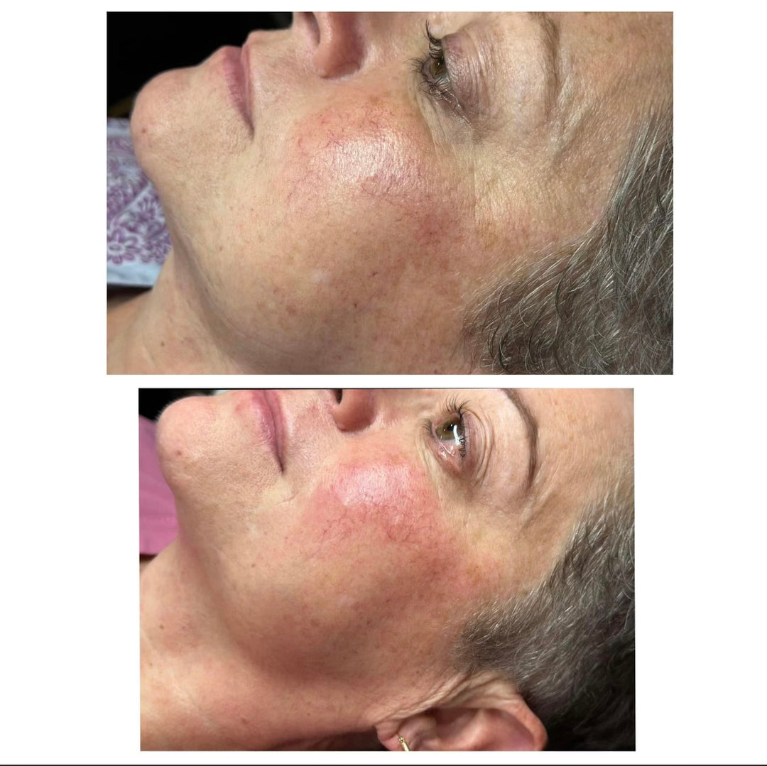 Unveil Youthful Radiance with Procell Micro-Channeling at Beauty Room Destin